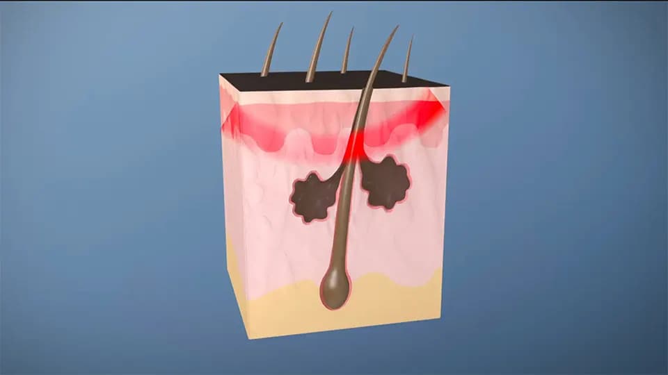 Sebacia | Medical Process Animation animation or motion graphics frame showing designed visual storytelling and production polish.