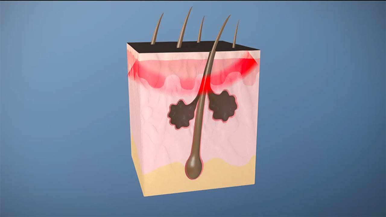 Sebacia | Medical Process Animation preview.