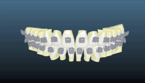 Ormco Insignia - Braces computer imaging shows perfect alignment of teeth.